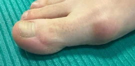 Лечение боли в косточке на ноге