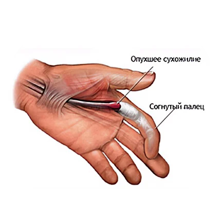 Хирургическое лечение болезни Нотта (щелкающий палец)